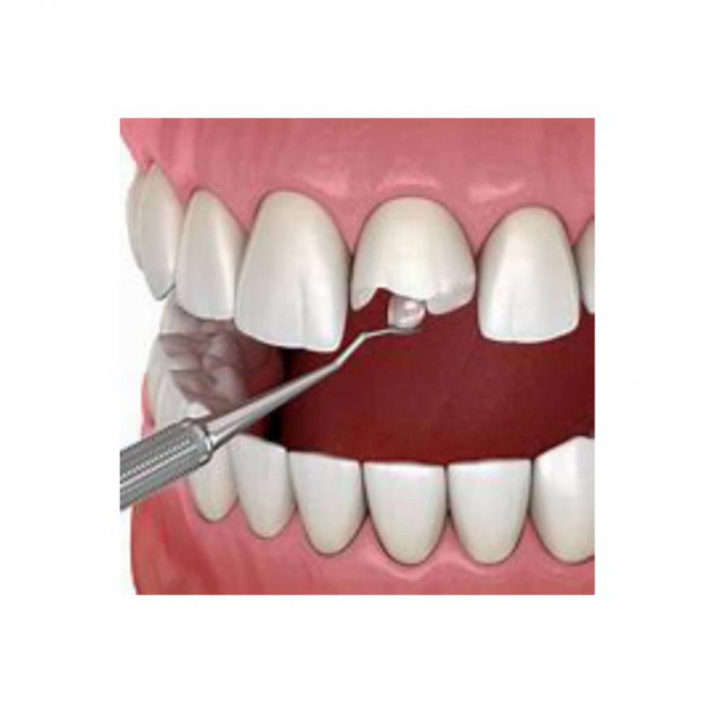 Kit de resina nanotecnológica para restauración dental. Color A3.5 - Miniatura 2