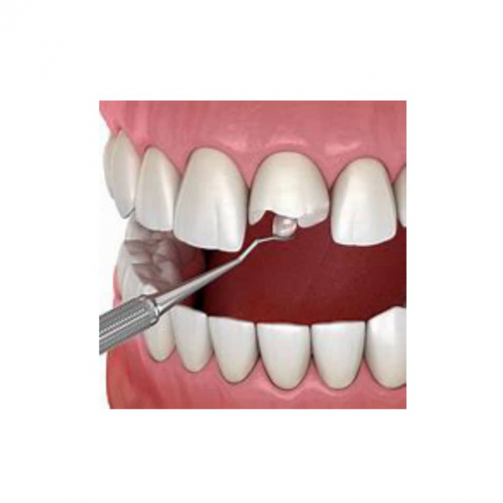 Kit de resina nanotecnológica para restauración dental. Color A2 - Miniatura 2