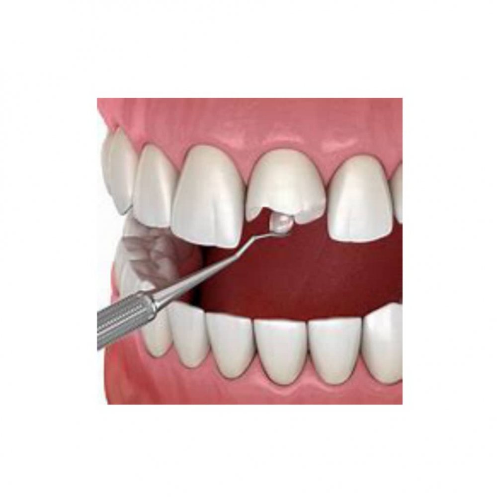 Kit de resina nanotecnológica para restauración dental. Color A3 - Miniatura 3